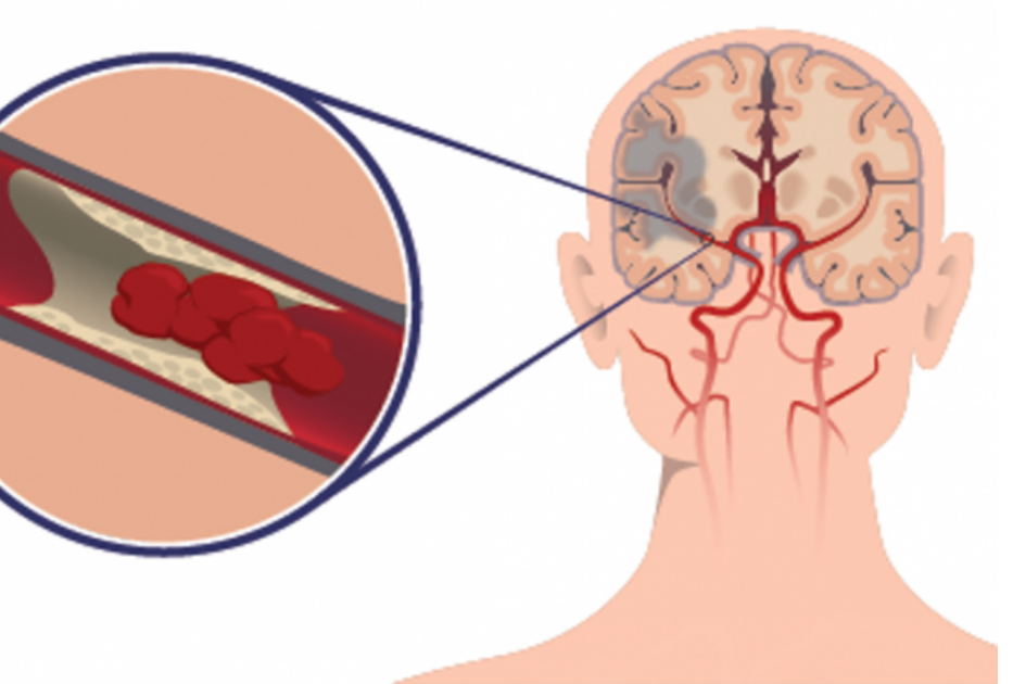 Ишемический инсульт артерии головы. Тромботический инсульт головного мозга. Головной микроинсульт